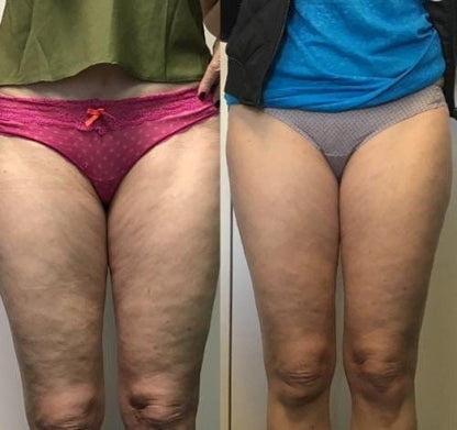 Anti-cellulite Massage Oil